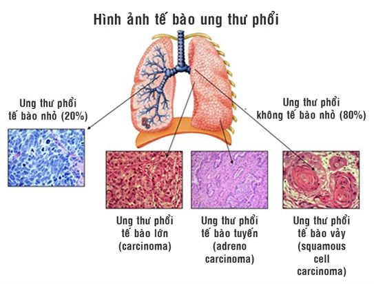 Phát hiện sớm 3 dấu ấn chính của ung thư phổi nhờ xét nghiệm máu - ảnh 1