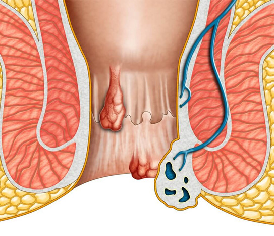 Căn bệnh khó nói thường chỉ xuất hiện ở người lớn tuổi nay bắt đầu phổ biến ở người trẻ làm văn phòng - ảnh 1