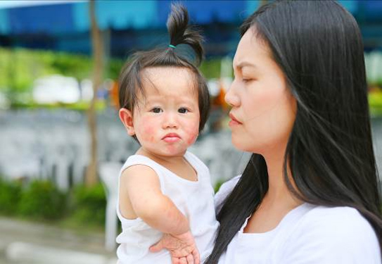 Làm gì để bảo vệ mình khi thủy đậu vào mùa? Làm gì để bảo vệ mình khi thủy đậu vào mùa? - ảnh 1