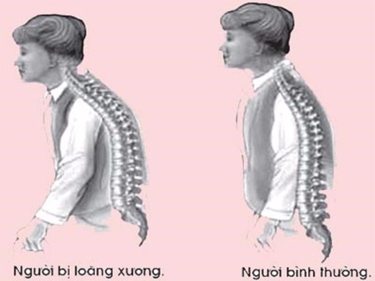 Tại sao dùng canxi đắt tiền vẫn bị loãng xương? Tại sao dùng canxi đắt tiền vẫn bị loãng xương? - ảnh 1