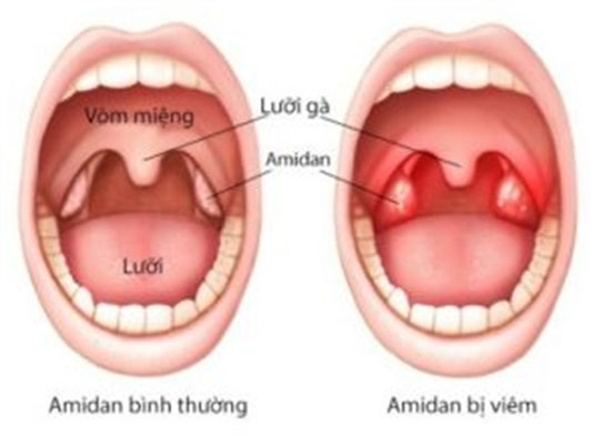 Làm gì khi viêm amidan và V.A ở trẻ - ảnh 1